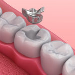 歯の詰め物で金属アレルギー！