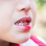 歯が折れてしまった時どうしたらいいの?~緊急時の対処法~