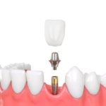 審美的にも良い？～インプラントについて～