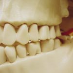 歯を失ってしまったらどうしたらいいの？～ブリッジの適用について～