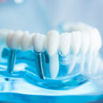 インプラント…その後のお手入れ