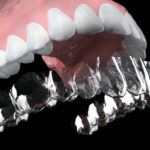 大人の歯科矯正~メリット・デメリットは?~