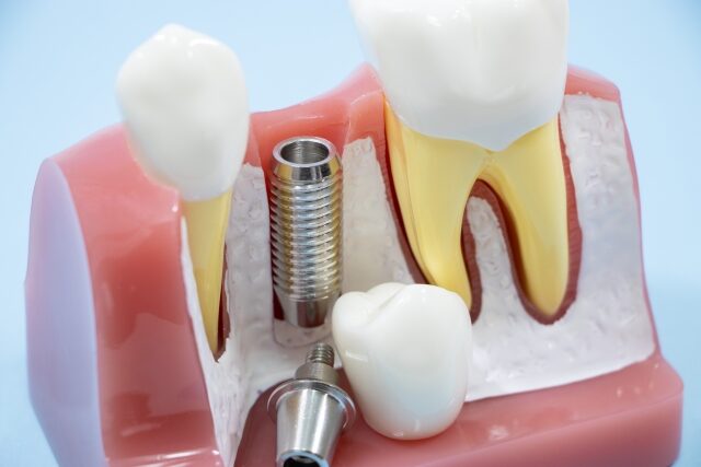 インプラント インプラント